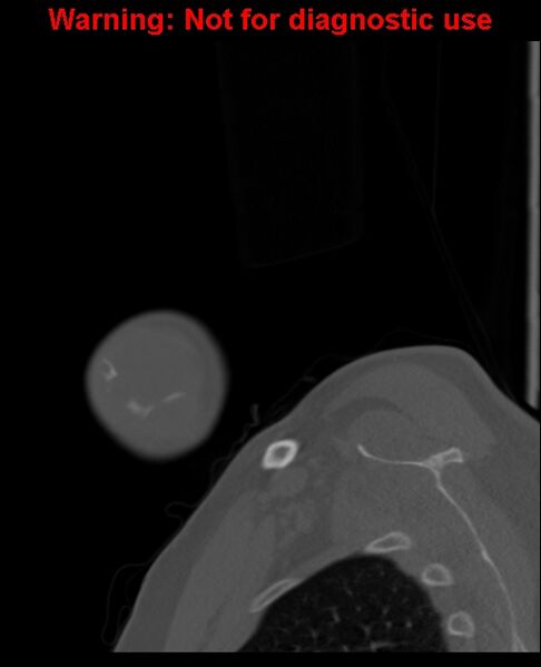 File:Ameloblastoma (Radiopaedia 33126-34164 Sagittal bone window 8).jpg