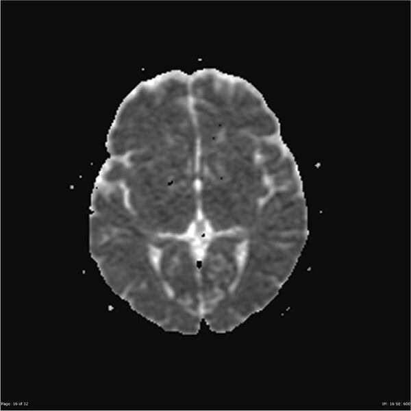 File:Amnestic syndrome secondary to hypoxic brain injury (Radiopaedia 24743-25004 ADC 16).jpg