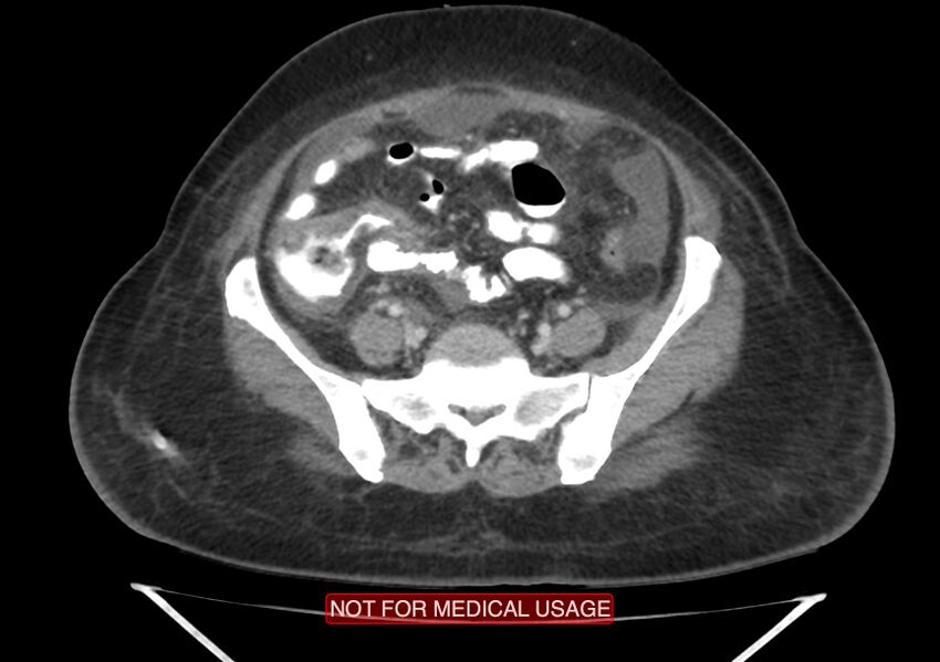 Amoebic enterocolitis with liver abscess (Radiopaedia 35100-36609 A 60).jpg