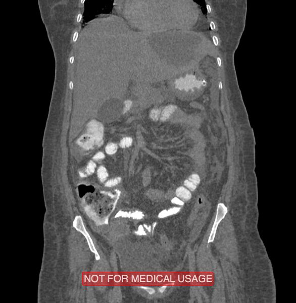 File:Amoebic enterocolitis with liver abscess (Radiopaedia 35100-36609 B 66).jpg