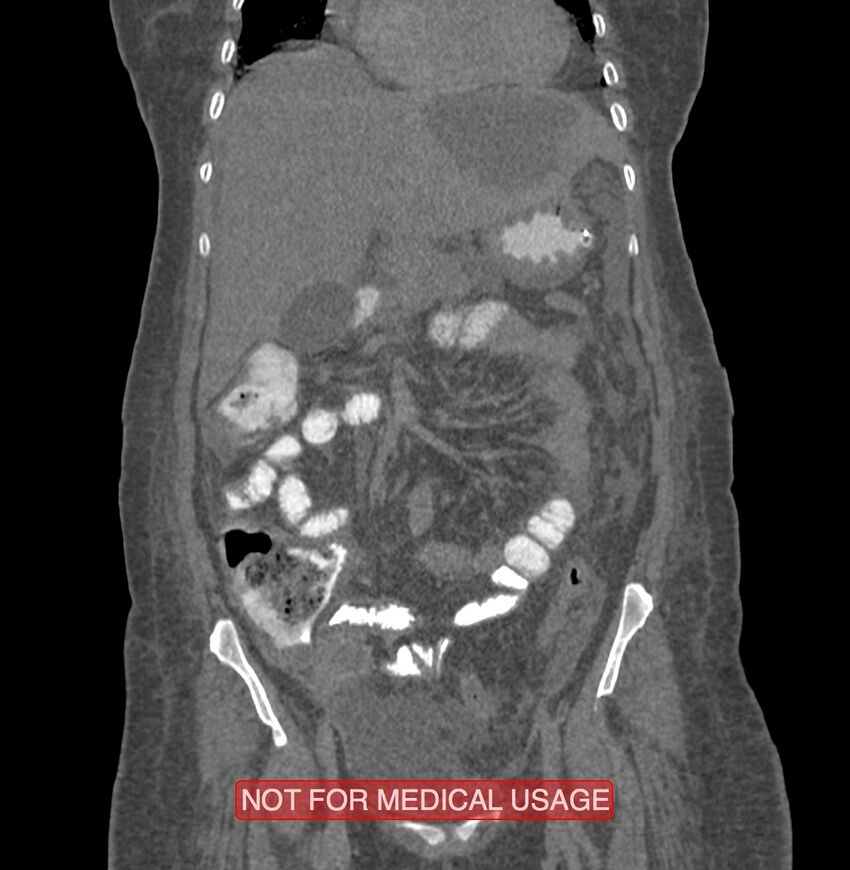 Amoebic enterocolitis with liver abscess (Radiopaedia 35100-36609 B 66).jpg