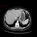 Ampullary carcinoma (Radiopaedia 56396-63056 B 17).jpg