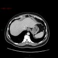 Ampullary carcinoma (Radiopaedia 56396-63056 C 15).jpg