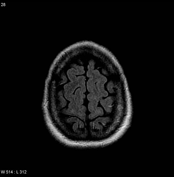 File:Amyotrophic lateral sclerosis (Radiopaedia 4719-6744 Axial FLAIR 10).jpg