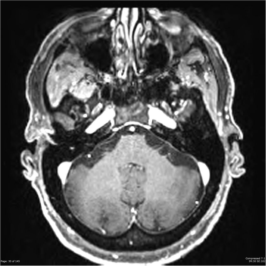 Anaplastic meningioma with recurrence (Radiopaedia 34452-35788 Axial T1 C+ 30).jpg
