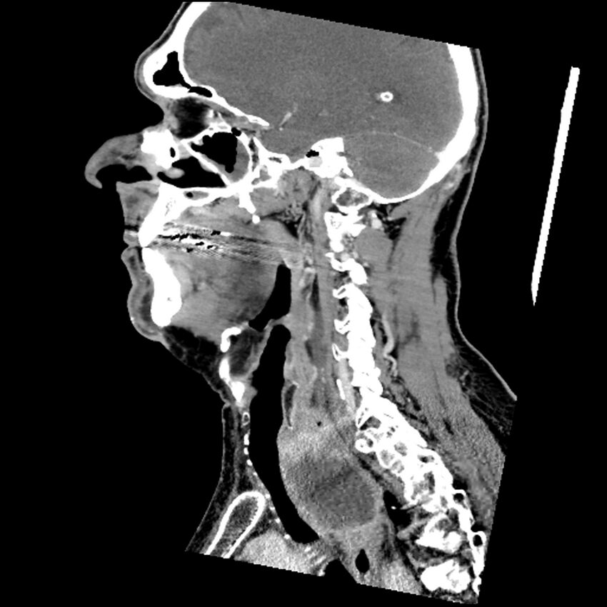 Anaplastic thyroid carcinoma (Radiopaedia 79087-92034 C 57).jpg