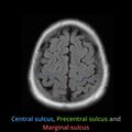 Anatomy- sulci of the brain (Radiopaedia 33834-34995 Central sulcus 5).jpg