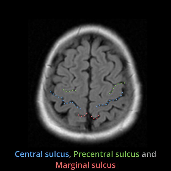 File:Anatomy- sulci of the brain (Radiopaedia 33834-34995 Central sulcus 5).jpg