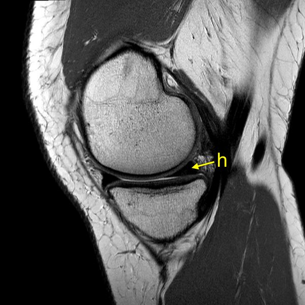 File:Anatomy Quiz (MRI knee) (Radiopaedia 43478-46865 A 6).jpeg