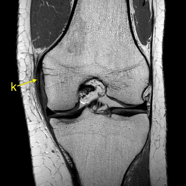 File:Anatomy Quiz (MRI knee) (Radiopaedia 43478-46874 A 15).jpeg