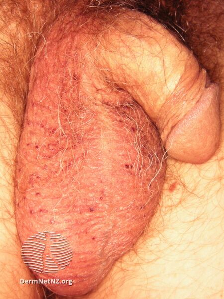 File:Angiokeratoma of Fordyce on scrotum (DermNet NZ angiokeratoma-37).jpg