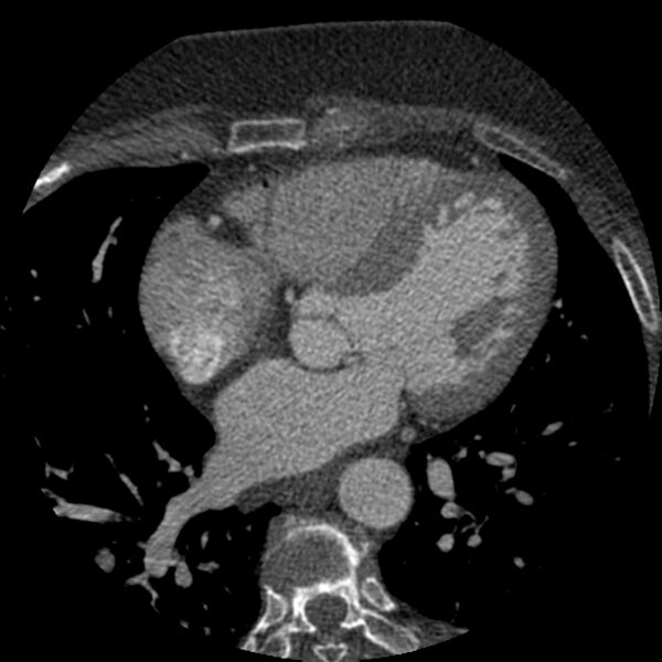 File:Anomalous origin of left circumflex artery from right coronary sinus (Radiopaedia 72563-83117 B 79).jpg