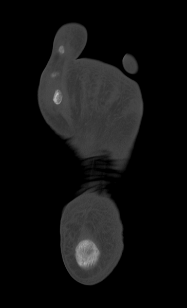 File:Anterior calcaneal process fracture (Radiopaedia 47384-51989 Axial bone window 31).png