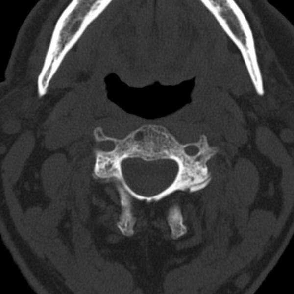 File:Anterior cervical postdiscectomy arthrodesis (Radiopaedia 32678-33646 Axial bone window 26).jpg