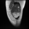 Anterior cruciate ligament tear, Wrisberg rip and bucket-handle tear of medial meniscus (Radiopaedia 75872-87266 Coronal T1 6).jpg
