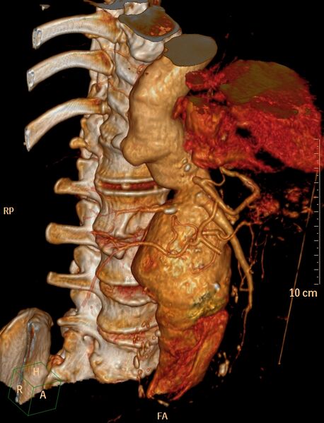 File:Anterior vertebral scalloping (abdominal aortic aneurysm) (Radiopaedia 66744-76067 B 3).jpg