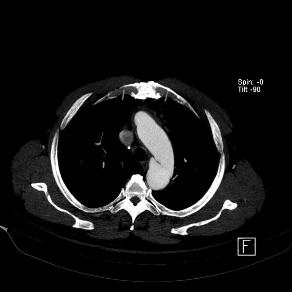 File:Aortic dissection - De Bakey type III - Stanford B (Radiopaedia 21903-21882 B 17).jpg