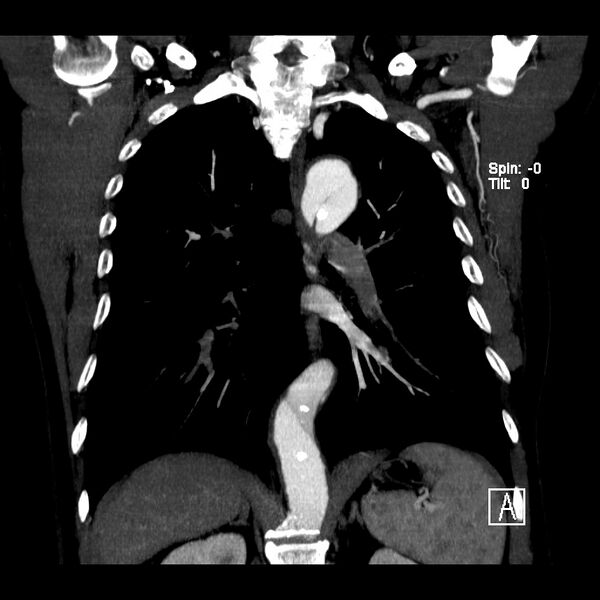 File:Aortic dissection - De Bakey type III - Stanford B (Radiopaedia 21903-21882 C 15).jpg