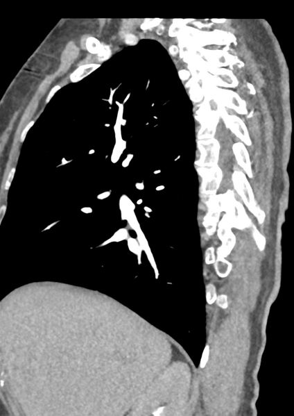 File:Aortic dissection - Stanford type B (Radiopaedia 50171-55512 C 48).png