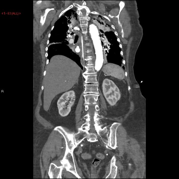 File:Aortic intramural hematoma (Radiopaedia 27746-28001 B 40).jpg