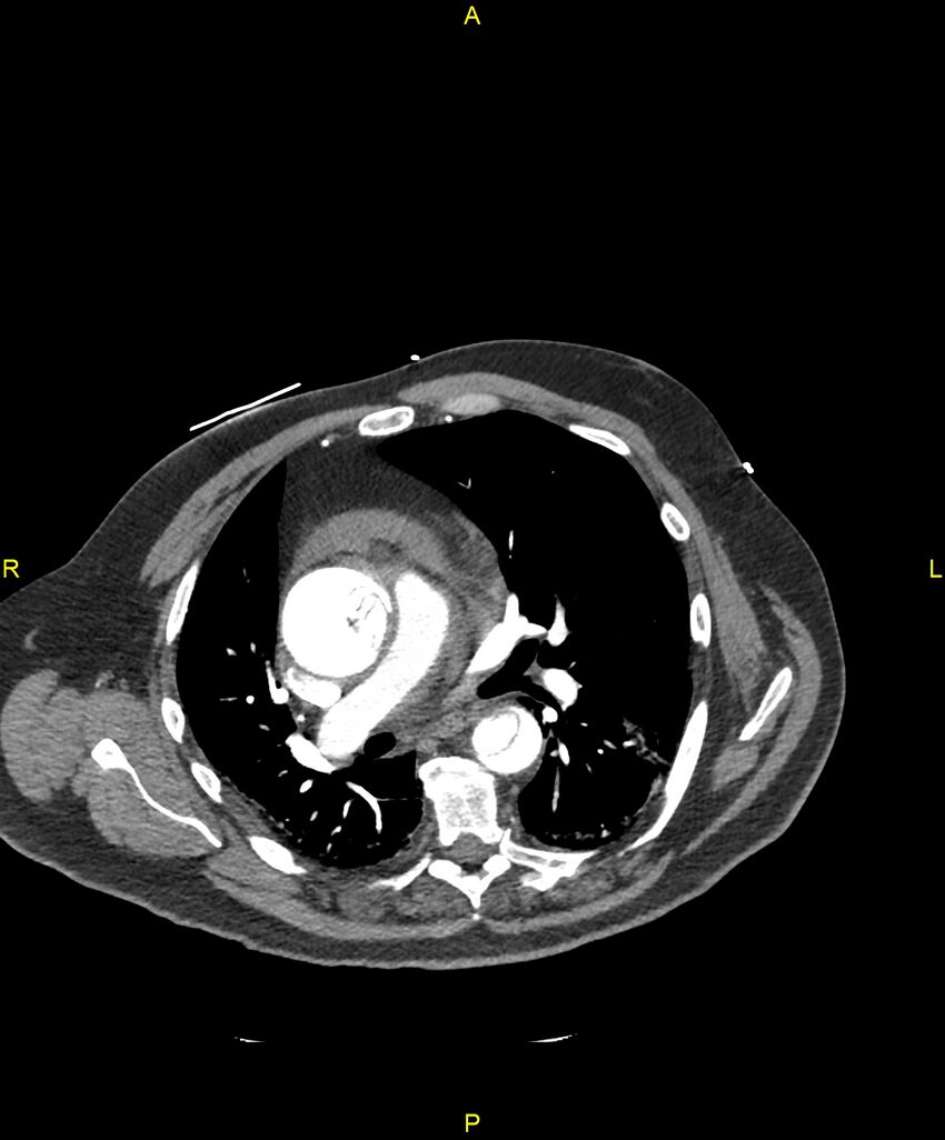 Aortic rupture (Radiopaedia 88822-105594 B 111).jpg