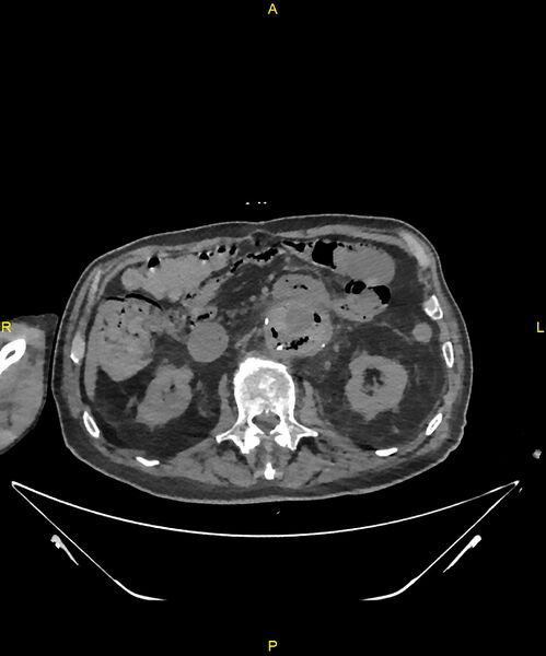File:Aortoenteric fistula (Radiopaedia 84308-99603 Axial non-contrast 141).jpg