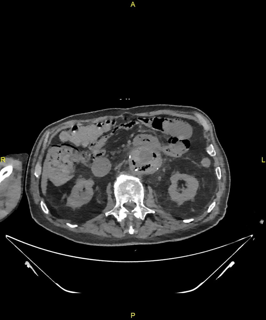 Aortoenteric fistula (Radiopaedia 84308-99603 Axial non-contrast 141).jpg