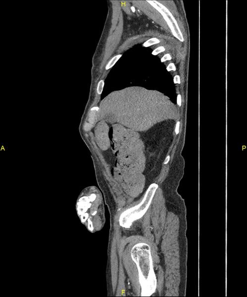 File:Aortoenteric fistula (Radiopaedia 84308-99603 C 56).jpg