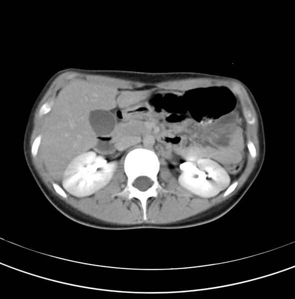File:Appendicitis and incidental bicornuate uterus (Radiopaedia 22833-22853 Axial C+ delayed 10).jpg