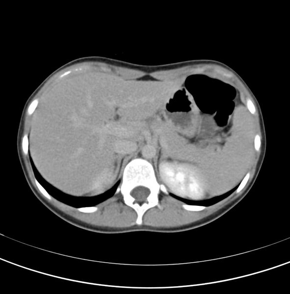 File:Appendicitis and incidental bicornuate uterus (Radiopaedia 22833-22853 Axial C+ delayed 5).jpg