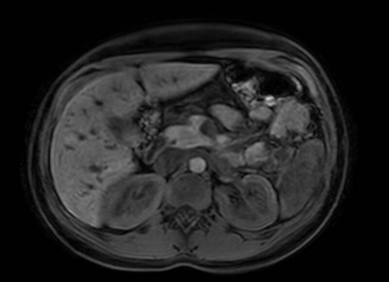 File:Appendicitis in gravida (MRI) (Radiopaedia 89433-106395 Axial DIXON 40).jpg
