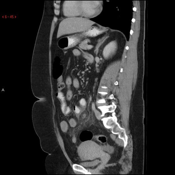File:Appendicitis with microperforation- promontoric type (Radiopaedia 27268-27442 A 30).jpg