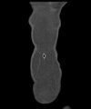 Appendicitis with minimal stranding but appendicolith (Radiopaedia 29035-29397 B 5).jpg