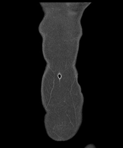 File:Appendicitis with minimal stranding but appendicolith (Radiopaedia 29035-29397 B 5).jpg