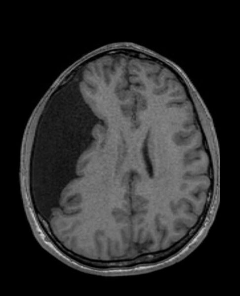 File:Arachnoid cyst- extremely large (Radiopaedia 68741-78451 Axial T1 50).jpg
