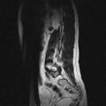 Arachnoid cyst - spinal (Radiopaedia 66835-76157 Sagittal T2 11).jpg