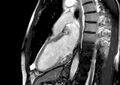 Arrhythmogenic right ventricular cardiomyopathy (Radiopaedia 39806-42237 B 29).jpg