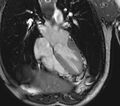 Arrhythmogenic right ventricular cardiomyopathy (Radiopaedia 39806-42237 D 82).jpg