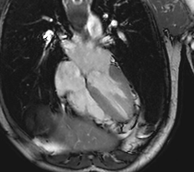 File:Arrhythmogenic right ventricular cardiomyopathy (Radiopaedia 39806-42237 D 82).jpg