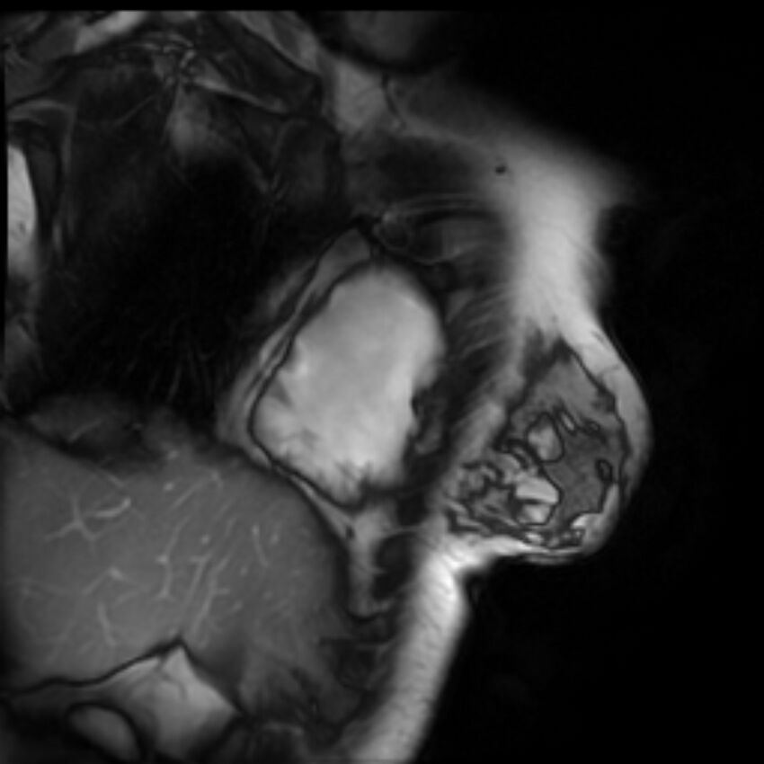 Arrhythmogenic right ventricular cardiomyopathy (Radiopaedia 87505-103850 2ch (RV) Cine SSFP 40).jpg