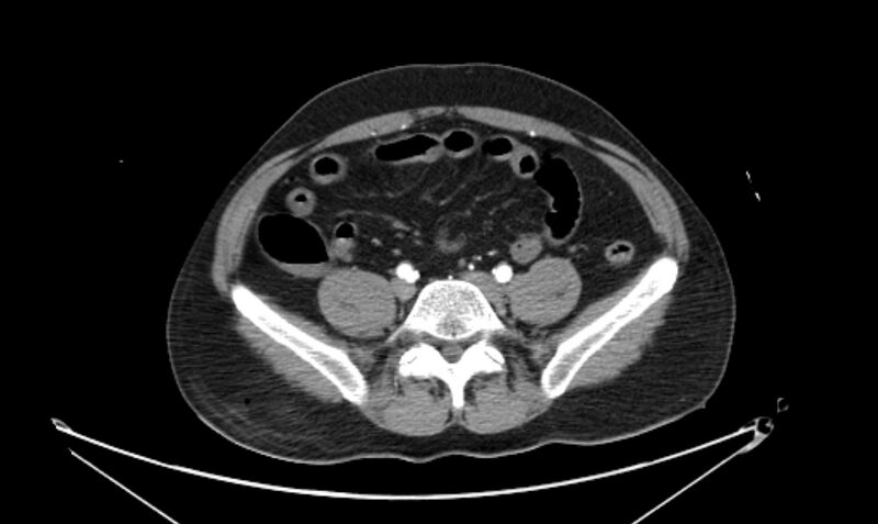 File:Arterial occlusive mesenteric ischemia (Radiopaedia 84641-100060 A 92).jpg