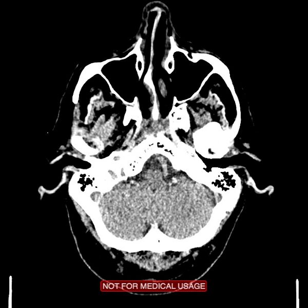 File:Artery of Percheron infarction (Radiopaedia 28679-28967 Axial non-contrast 20).jpg