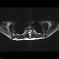 Arthrogryposis and muscle atrophy (Radiopaedia 24081-24314 B 5).jpg