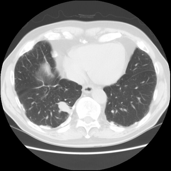 File:Asbestos-related pleural plaques (Radiopaedia 39069-41255 Axial lung window 54).jpg