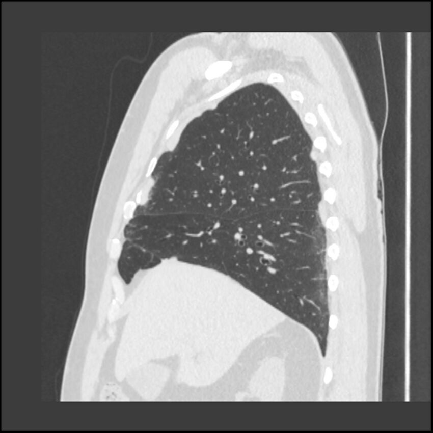 Asbestosis (Radiopaedia 45002-48961 Sagittal lung window 96).jpg