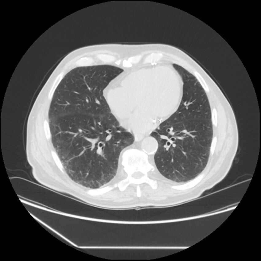 Asbestosis complicated by lung cancer (Radiopaedia 45834-50116 Axial lung window 45).jpg