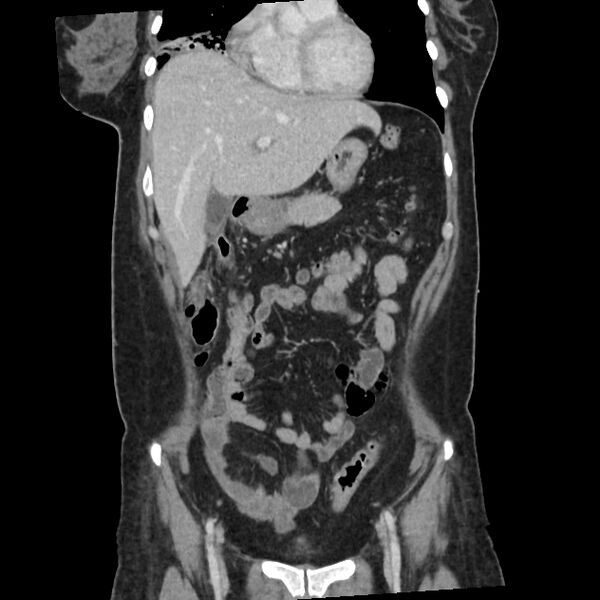 File:Ascending retrocecal appendicitis with liver abscesses (Radiopaedia 60066-67615 C 30).jpg