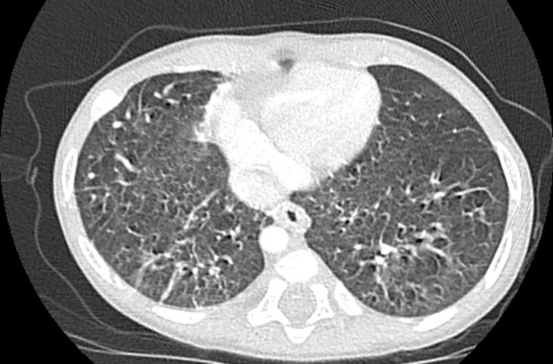 File:Asplenia syndrome (Radiopaedia 73083-83792 Axial lung window 56).jpg