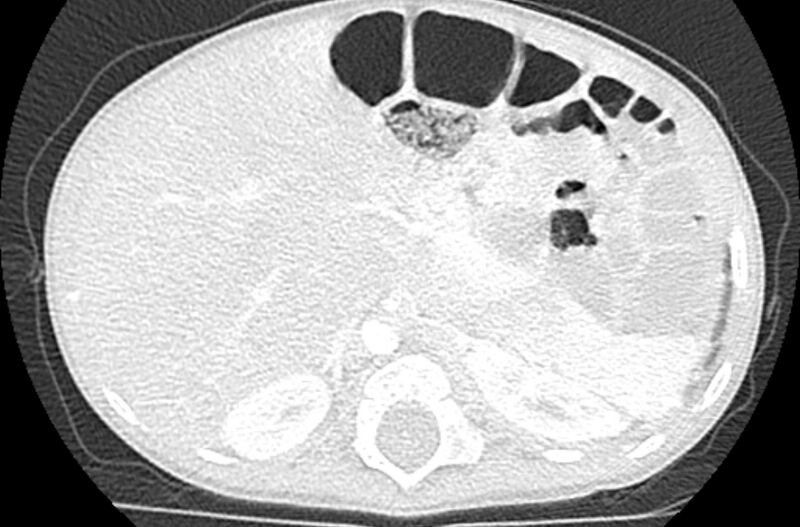 File:Asplenia syndrome (Radiopaedia 73083-83792 Axial lung window 78).jpg