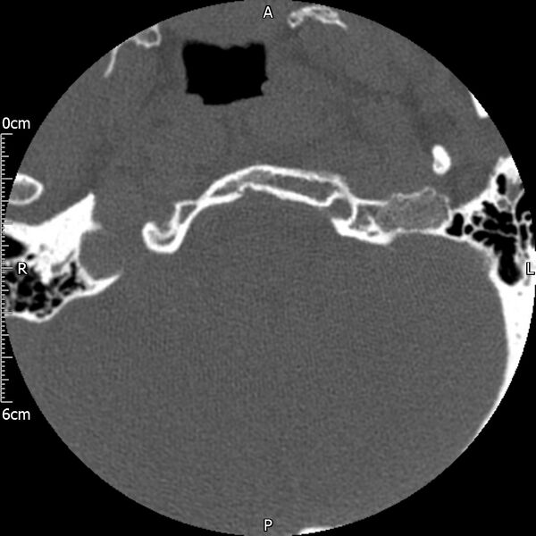 File:Atlas fracture with Currarino type A congenital defect (Radiopaedia 71747-82144 Axial bone window 3).jpg